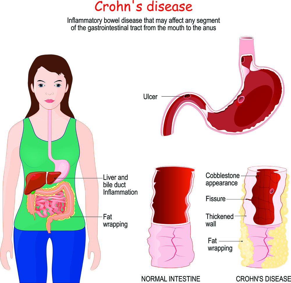 infrared-saunas-and-crohns-disease