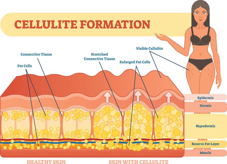 Cellulite formation - far infrared saunas