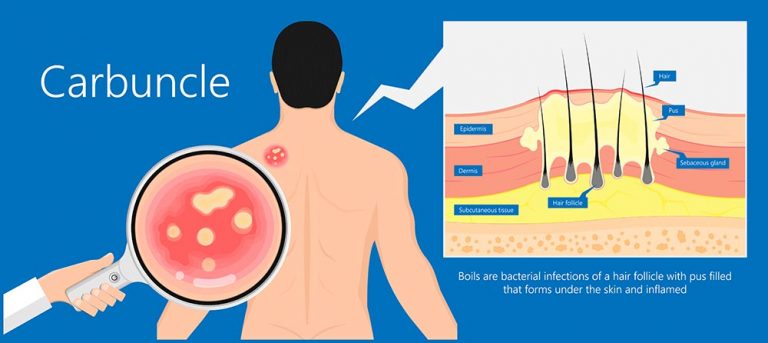 minor staphylococcus infection